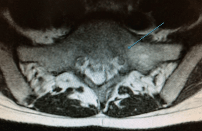 sacral stress fracture icd 10